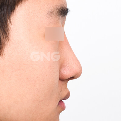 整形前后的照片