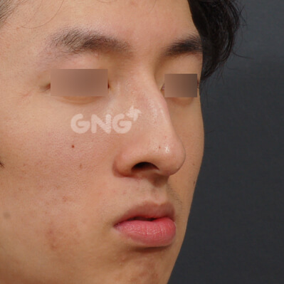 整形前后的照片