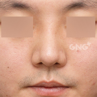 整形前后的照片