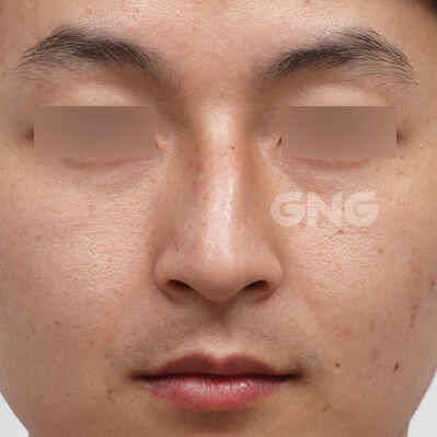 整形前后的照片