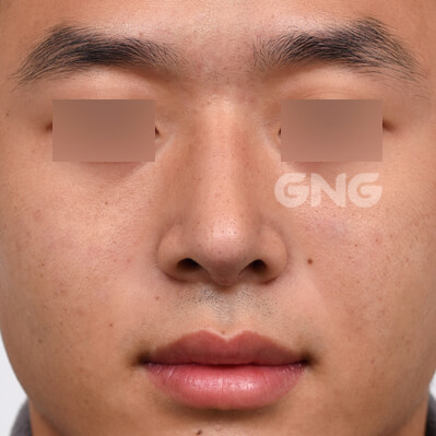 整形前后的照片