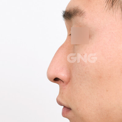 整形前后的照片
