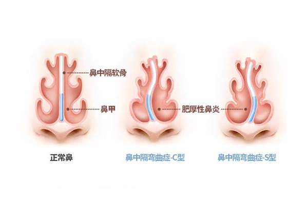 鼻中隔弯曲和正常鼻对比