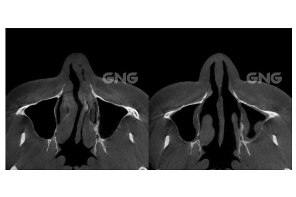 GNG医院改善功能鼻＋美容鼻病例分享